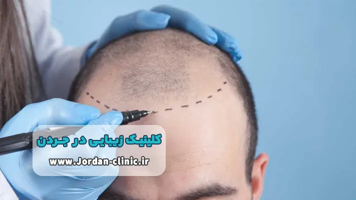 بهترین کلینیک زیبایی برای کاشت مو در جردن